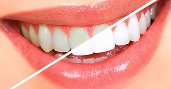 Избелете зъбите си по естествен начин, без химикали