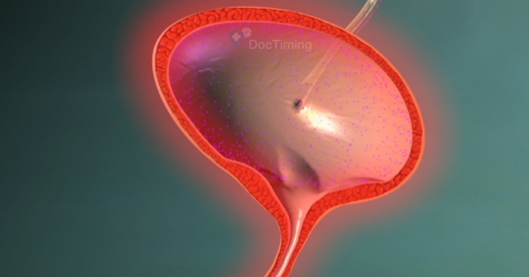Изградиха нов пикочен мехур на мъж в столична болница