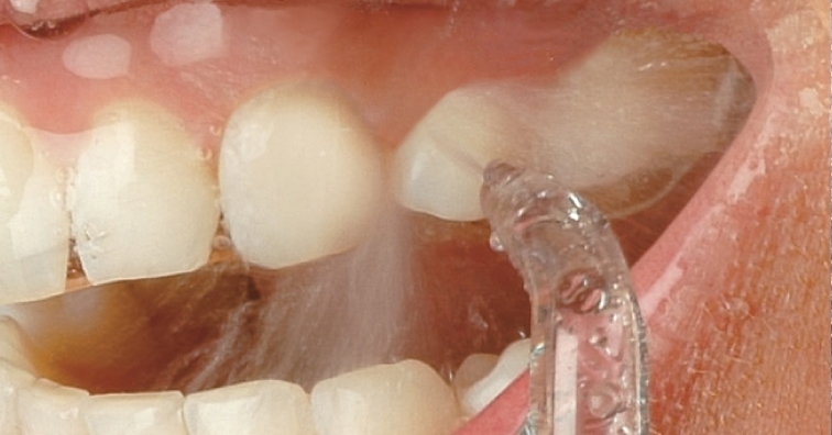 Проблемите със зъбите водят до сериозни вътрешни увреждания
