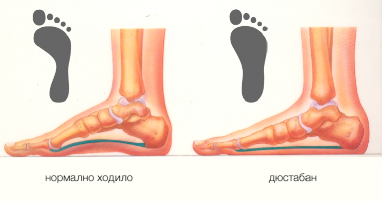 Как да избегнем усложнения от дюстабан
