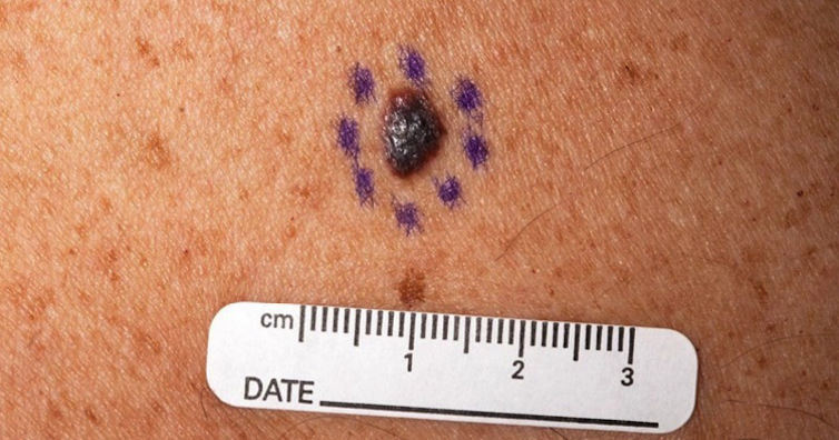 При асиметрична бенка, която сърби и кърви - на дерматолог!