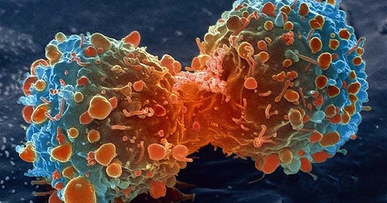 Раковите заболявания се увеличават в страните с ниски доходи, приемащи западния начин на живот