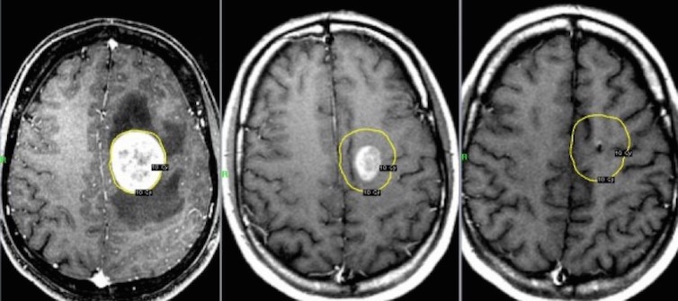 Как да се предпазим от рак на главата и шията?