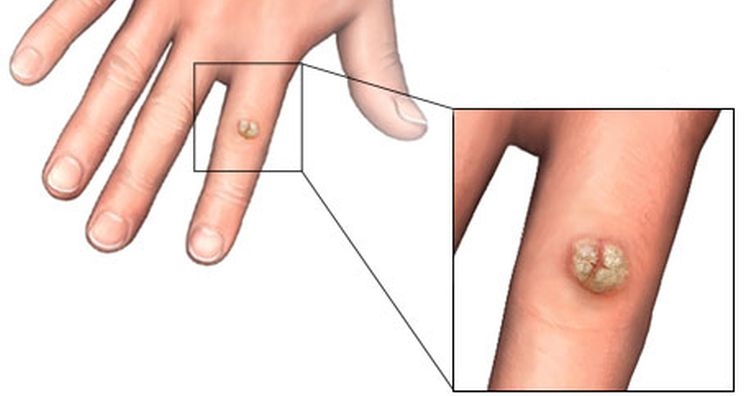 Домашна високоефективна рецепта срещу брадавици и кокоши трън